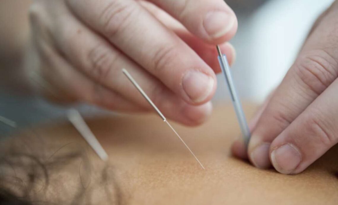 Acupuncture Can Support Your Health